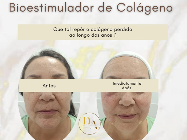 Bioestimulador de Colágeno em Realengo RJ