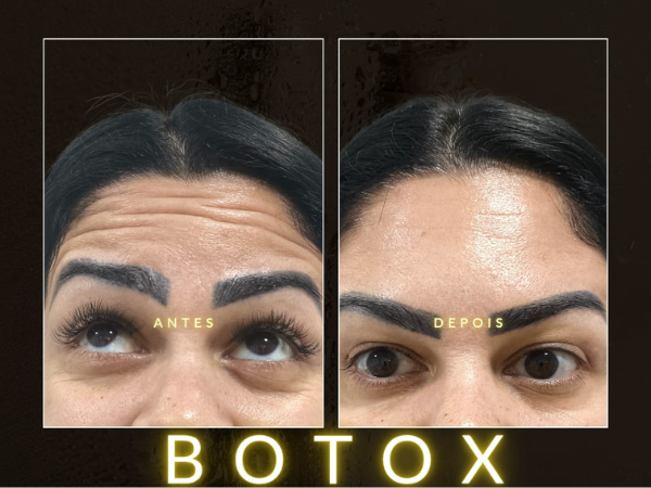 Toxina Botulínica Botox em Realengo RJ