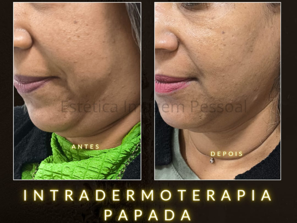 Enzima para Papada em Realengo RJ