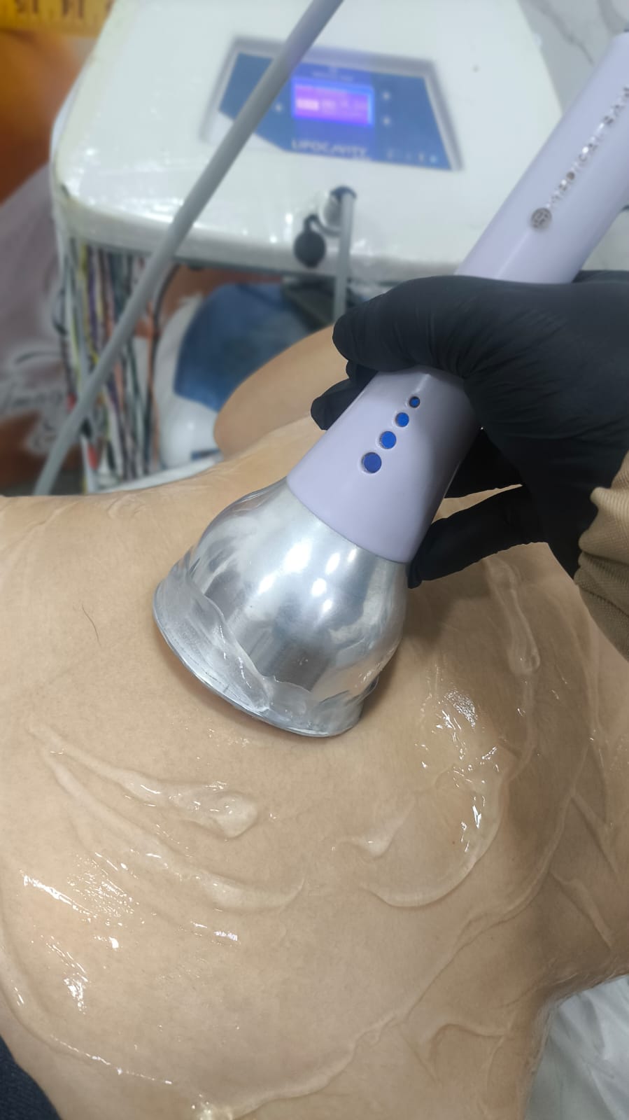Tratamento de Gordura Localizada Abdômen Rio de Janeiro RJ