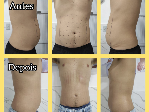 Intradermoterapia em Realengo RJ