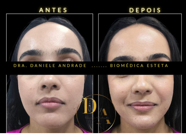 Preenchimento Facial em Realengo RJ