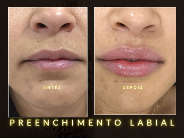 Preenchimento Labial em Realengo RJ